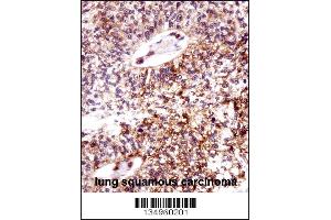 ECT2 Antibody immunohistochemistry analysis in formalin fixed and paraffin embedded human lung squamous carcinoma followed by peroxidase conjugation of the secondary antibody and DAB staining. (ECT2 antibody  (AA 597-625))
