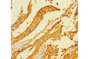 Immunohistochemistry of paraffin-embedded human endometrial cancer using ABIN7165442 at dilution of 1:100 (FAM167A antibody  (AA 1-214))