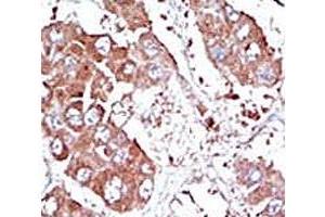 IHC analysis of FFPE human hepatocarcinoma tissue stained with the ALK3 antibody (BMPR1A antibody  (AA 166-195))