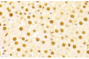 Immunohistochemistry of paraffin-embedded Human liver damage using CDC25A Polyclonal Antibody at dilution of 1:100 (40x lens). (CDC25A antibody)
