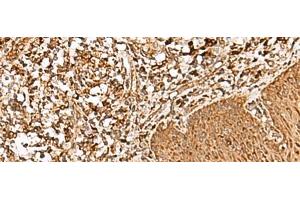 Immunohistochemistry of paraffin-embedded Human esophagus cancer tissue using FAM200A Polyclonal Antibody at dilution of 1:55(x200) (FAM200A antibody)