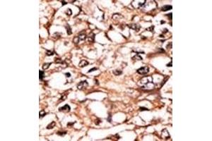 Formalin-fixed and paraffin-embedded human cancer tissue reacted with the primary antibody, which was peroxidase-conjugated to the secondary antibody, followed by DAB staining. (TNFRSF1A antibody  (pSer274))