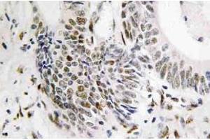 Immunohistochemistry (IHC) analyzes of Rad51 antibody in paraffin-embedded human colon carcinoma tissue. (RAD51 antibody)