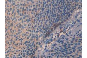 DAB staining on IHC-P; Samples: Human Skin cancer Tissue (SLIT3 antibody  (AA 1405-1512))