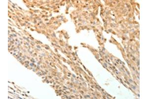The image on the left is immunohistochemistry of paraffin-embedded Human cervical cancer tissue using ABIN7130780(PTPRE Antibody) at dilution 1/10, on the right is treated with fusion protein. (PTPRE antibody)