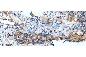 Immunohistochemistry of paraffin-embedded Human cervical cancer tissue using DEFB104A Polyclonal Antibody at dilution of 1:50(x200) (DEFB104A antibody)