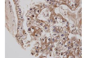 IHC-P Image Immunohistochemical analysis of paraffin-embedded human ovarian cancer, using CB1 , antibody at 1:100 dilution.