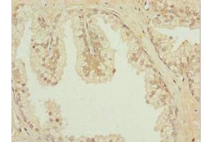 Immunohistochemistry of paraffin-embedded human prostate cancer using ABIN7156889 at dilution of 1:100 (IL31RA antibody  (AA 1-300))