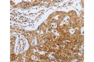 Immunohistochemistry of Human lung cancer using CASP12 Polyclonal Antibody at dilution of 1:50 (Caspase 12 antibody)