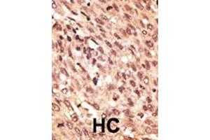 Formalin-fixed and paraffin-embedded human hepatocellular carcinoma tissue reacted with LRP5 polyclonal antibody , which was peroxidase-conjugated to the secondary antibody, followed by AEC staining. (LRP5 antibody  (C-Term))