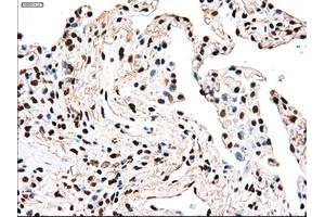 Immunohistochemical staining of paraffin-embedded Adenocarcinoma of breast tissue using anti-TYRO3 mouse monoclonal antibody. (TYRO3 antibody)