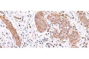 Immunohistochemistry of paraffin-embedded Human esophagus cancer tissue using RUSC1 Polyclonal Antibody at dilution of 1:90(x200)