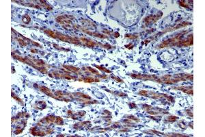 Formalin-fixed, paraffin-embedded human Leiomyosarcoma stained with Caldesmon Mouse Monoclonal Antibody (h-CALD). (Caldesmon antibody)