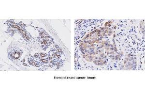 Paraffin embedded sections of human breast canitrocelluloseer tissue were initrocelluloseubated with anti-human Wnt3a (1:50) for 2 hours at room temperature. (WNT3A antibody  (AA 19-352))