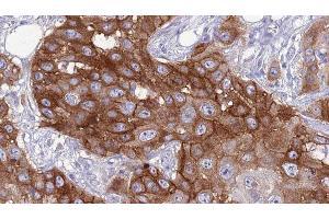 ABIN6276799 at 1/100 staining Human Head and neck cancer tissue by IHC-P. (SELPLG antibody  (N-Term))