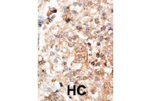 Formalin-fixed and paraffin-embedded human hepatocellular carcinoma tissue reacted with BGLAP polyclonal antibody  , which was peroxidase-conjugated to the secondary antibody, followed by DAB staining. (Osteocalcin antibody  (N-Term))