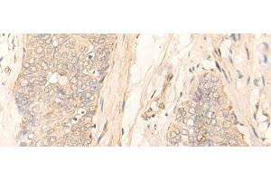 Immunohistochemistry of paraffin-embedded Human esophagus cancer tissue using GK5 Polyclonal Antibody at dilution of 1:35(x200) (GK5 antibody)