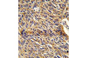 Formalin-fixed and paraffin-embedded human lung carcinoma reacted with DCI Antibody (C-term), which was peroxidase-conjugated to the secondary antibody, followed by DAB staining. (DCI antibody  (C-Term))
