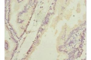 Immunohistochemistry of paraffin-embedded human prostate cancer using ABIN7154846 at dilution of 1:100 (HAND2 antibody  (AA 1-217))