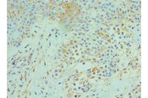 Immunohistochemistry of paraffin-embedded human breast cancer using ABIN7170676 at dilution of 1:100 (SRPK1 antibody  (AA 290-480))