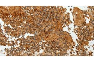 Immunohistochemistry of paraffin-embedded Human tonsil tissue using TFF2 Polyclonal Antibody at dilution 1:40 (Trefoil Factor 2 antibody)