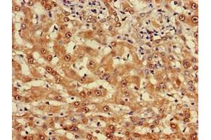 Immunohistochemistry of paraffin-embedded human liver cancer using ABIN7174961 at dilution of 1:100 (Myosin VIIA antibody  (AA 838-968))