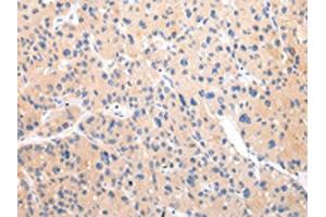 The image on the left is immunohistochemistry of paraffin-embedded Human liver cancer tissue using ABIN7193105(ZNF106 Antibody) at dilution 1/20, on the right is treated with synthetic peptide. (ZNF16 antibody)