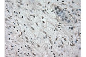 Immunohistochemical staining of paraffin-embedded Carcinoma of kidney tissue using anti-NEK6mouse monoclonal antibody. (NEK6 antibody)