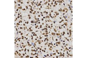 Immunohistochemistry of paraffin-embedded human kidney cancer tissue using H4K20me3 antibody at dilution of 1:200 (x400 lens). (Histone H4 antibody  (3meLys20))