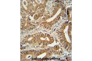 CCDC123 antibody (C-term) immunohistochemistry analysis in formalin fixed and paraffin embedded human colon carcinoma followed by peroxidase conjugation of the secondary antibody and DAB staining. (CEP89 antibody  (C-Term))