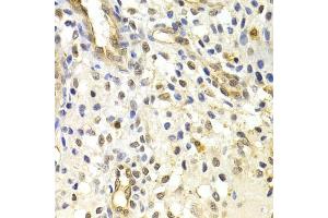 Immunohistochemistry of paraffin-embedded human uterine cancer using RAD50 Antibody. (RAD50 antibody)