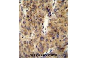 ACF Antibody (C-term) (ABIN654627 and ABIN2844324) immunohistochemistry analysis in formalin fixed and paraffin embedded human hepatocarcinoma followed by peroxidase conjugation of the secondary antibody and DAB staining. (A1CF antibody  (C-Term))