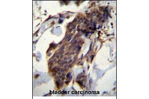 CCDC13 Antibody (N-term) (ABIN656615 and ABIN2845868) immunohistochemistry analysis in formalin fixed and paraffin embedded human bladder carcinoma followed by peroxidase conjugation of the secondary antibody and DAB staining. (CCDC13 antibody  (N-Term))
