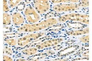 ABIN6263049 and ABIN6273132 at 1/100 staining Human kidney cancer and adjacent normal tissues by IHC-P. (MAD2L2 antibody  (Internal Region))