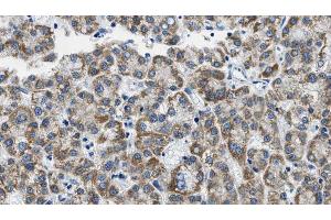 ABIN6268888 at 1/100 staining Human liver cancer tissue by IHC-P. (CD4 antibody  (C-Term))
