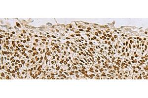 Immunohistochemistry of paraffin-embedded Human lung cancer tissue using TP63 Polyclonal Antibody at dilution of 1:65(x200) (p63 antibody)