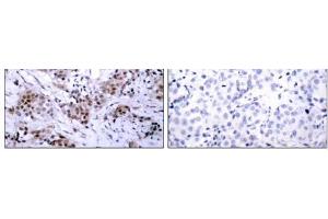 Immunohistochemical analysis of paraffin-embedded human breast carcinoma tissue using Estrogen Receptor-α (Ab-167) antibody (E021068). (Estrogen Receptor alpha antibody)