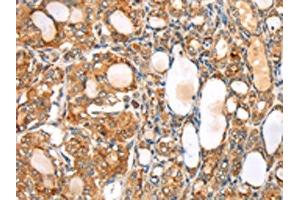 The image on the left is immunohistochemistry of paraffin-embedded Human thyroid cancer tissue using ABIN7192531(SLC8B1 Antibody) at dilution 1/20, on the right is treated with synthetic peptide. (SLC24A6 antibody)