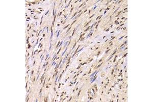 Immunohistochemistry of paraffin-embedded human adenomyosis using SNRPA Antibody. (SNRPA1 antibody  (AA 1-282))