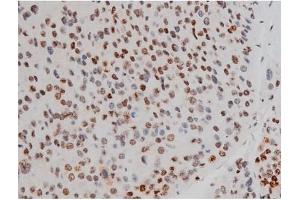 ABIN6267389 at 1/200 staining Human liver cancer tissue sections by IHC-P. (ATF2 antibody  (pThr51, pThr69))