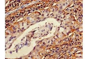 Immunohistochemistry of paraffin-embedded human lung cancer using ABIN7174772 at dilution of 1:100 (NMNAT2 antibody  (AA 1-183))