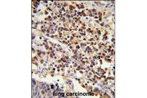 Formalin-fixed and paraffin-embedded human lung carcinoma reacted with , which was peroxidase-conjugated to the secondary antibody, followed by DAB staining. (U2AF1 antibody  (AA 99-125))