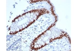 IHC analysis of formalin-fixed, paraffin-embedded human colon adenocarcinoma. (Recombinant CDX2 antibody)