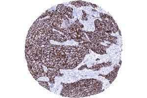 Squamous cell carcinoma of the penis with intense membranous Dsg3 immunostaining of tumor cells (Desmoglein 3 antibody  (AA 379-491))