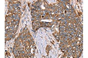 The image on the left is immunohistochemistry of paraffin-embedded Human cervical cancer tissue using ABIN7129551(FUCA1 Antibody) at dilution 1/30, on the right is treated with fusion protein.