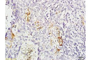 Formalin-fixed and paraffin-embedded: human esophageal cancer labeled with Rabbit Anti-CD11C Polyclonal Antibody, Unconjugated  1:200 followed by conjugation to the secondary antibody and DAB staining (CD11b antibody  (AA 520-570))