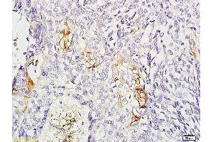 Formalin-fixed and paraffin-embedded: human esophageal cancer labeled with Rabbit Anti-CD11C Polyclonal Antibody, Unconjugated  1:200 followed by conjugation to the secondary antibody and DAB staining (CD11b antibody  (AA 520-570))