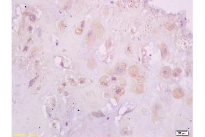 Formalin-fixed and paraffin embedded human placenta tissue labeled with Anti-Phospho-Estrogen Receptor alpha (Ser118) Polyclonal Antibody, Unconjugated (ABIN684568) at 1:200 followed by conjugation to the secondary antibody and DAB staining (Estrogen Receptor alpha antibody  (pSer118))