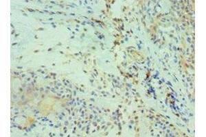 Immunohistochemistry of paraffin-embedded human breast cancer using ABIN7146211 at dilution of 1:100 (Cadherin 13 antibody  (AA 120-370))
