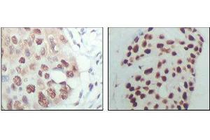 Immunohistochemical analysis of paraffin-embedded human esophagus cancer (left) and breast carcinoma tissue (right), showing nuclear localization with DAB staining using HDAC3 mouse mAb.